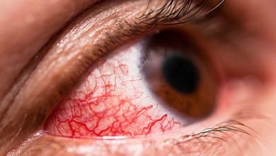 علل شایع قرمزی چشم و راه درمان آن