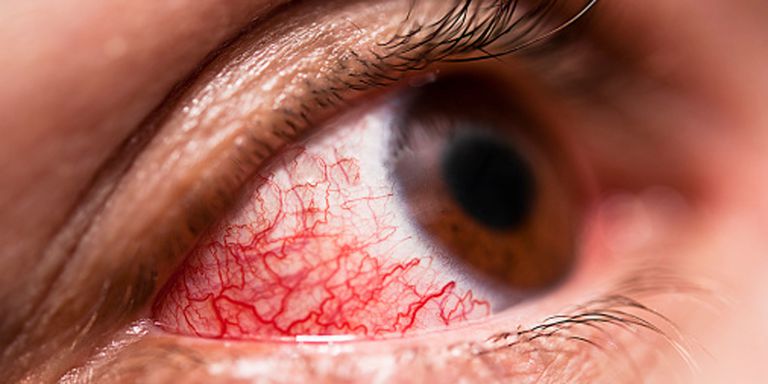 علل شایع قرمزی چشم و راه درمان آن