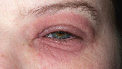 علل قرمزی چشم و درمان آن