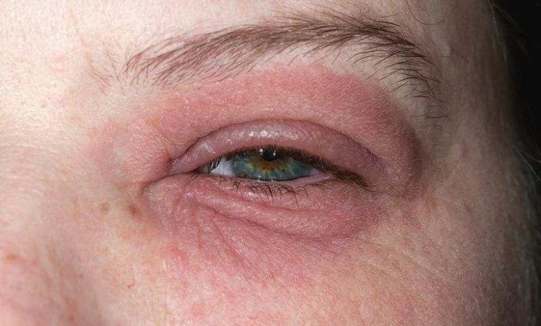 علل قرمزی چشم و درمان آن